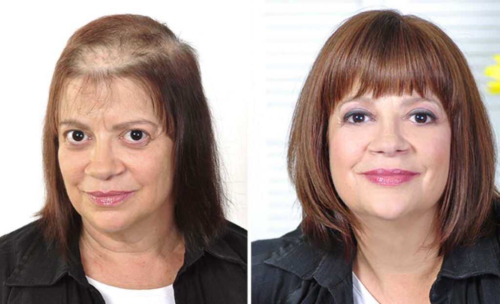 Confident Look Hair Wig2 services in bangalore