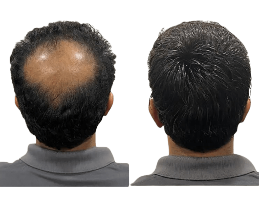 HAIR Patches in Bangalore Confident look Bangalore