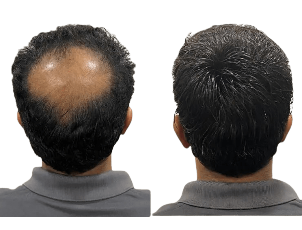 HAIR Patches in Bangalore Confident look Bangalore